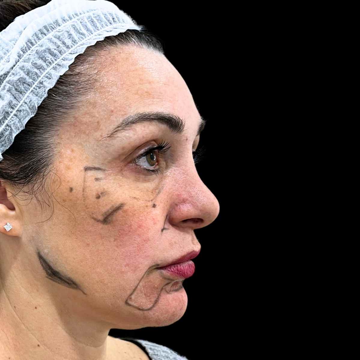 Imagen tratamiento de armonización facial en Clinica Roma, la mejor clinica estetica Malaga