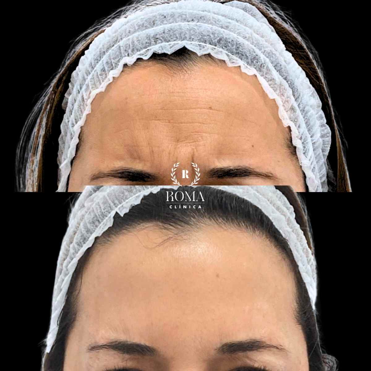 imagen antes y después paciente procedimiento neuromoduladores