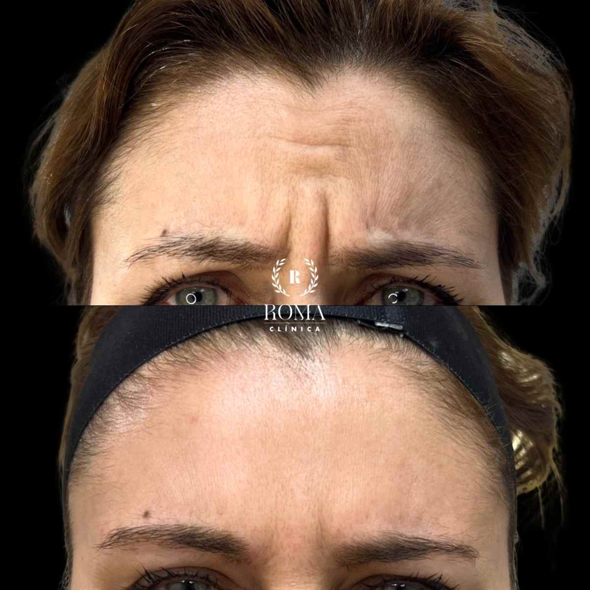 Imagen antes y después líneas de expresión procedimiento neuromoduladores