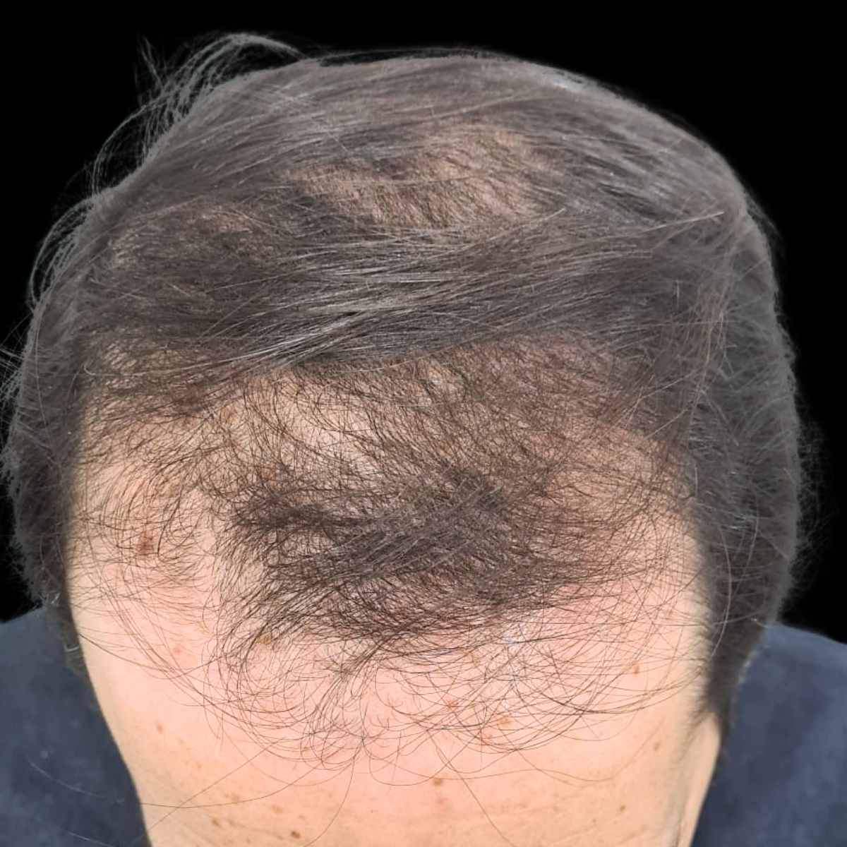 Antes del tratamiento capilar en la mejor clinica estetica malaga, Clinica Roma