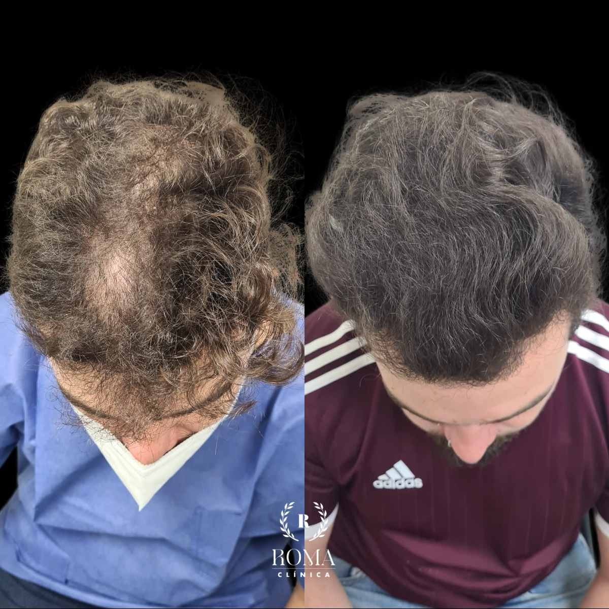 Antes y después de tratamiento capilar en Clinica Roma, la mejor clinica estetica Malaga