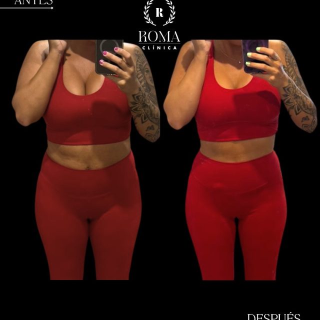 Los resultados no llegan por casualidad, llegan con un plan y un buen acompañamiento. 

Evolución en 3 meses | Paciente de 38 años

• Peso: 80,3 kg → 65 kg
• Grasa corporal: 20% → 15%
• Grasa visceral: 7 → 5
• Talla: L → M

Detrás de esta transformación hay mucho más que una pérdida de peso. Hay constancia, compromiso y un plan nutricional adaptado a las necesidades y objetivos de la paciente.

En Clínica Roma creemos que cada persona es única, por eso diseñamos programas de nutrición completamente personalizados, con seguimiento continuo, valoración de la composición corporal y ajustes durante todo el proceso para conseguir resultados reales y sostenibles.

Porque no se trata solo de bajar kilos, sino de mejorar tu salud, sentirte mejor y aprender hábitos que perduren en el tiempo.

¿Quieres empezar tu cambio? Escríbenos y te acompañamos durante todo el proceso.

📲 951 536 845 / 655 538 090 / 645 020 214
📍 Dirección: Trinidad Grund 7, 1D, Málaga Centro
🌐 Página web: www.clinicasroma.com

“Resultados individuales. Cada paciente puede obtener resultados diferentes. Valoración médica previa necesaria.”

#perdidadegrasa #malaga #clinicaroma #cuerposaludable