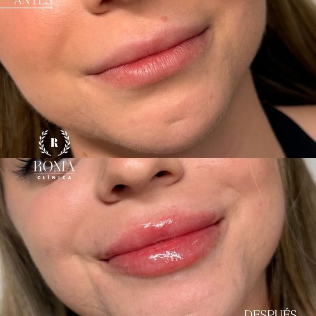 Nuestra paciente Marina Torres (@_marinatoorres)confió en Clínica Roma para realizarse su tratamiento de aumento de labios. 💋

Buscábamos un resultado natural y armónico, respetando sus facciones y realzando la belleza de sus labios.

Gracias, Marina, por confiar en nuestro equipo. 🤍

¿Estás pensando en realizarte un aumento de labios? Reserva tu valoración personalizada en Clínica Roma.

“Resultados individuales. Cada paciente puede obtener resultados diferentes. Valoración médica previa necesaria.”

📲 951 536 845 / 645 020 214 / 655 538 090
📍 Dirección: Trinidad Grund 7, 1D, Málaga Centro
🌐 Página web: www.clinicasroma.com

#aumentodelabios #malaga #verano #labios #clinicaroma