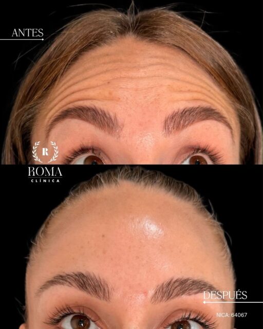 Rejuvenecer tu expresión no significa cambiarla.

En Clínica Roma entendemos la medicina estética como una forma de acompañar tus rasgos, respetando siempre la naturalidad y la expresión de tu rostro.

Mediante la aplicación estratégica de neuromoduladores en puntos específicos, podemos suavizar determinadas líneas de expresión y ayudar a prevenir que se marquen con mayor intensidad.

¿El objetivo? Una apariencia más fresca, relajada y descansada, manteniendo la esencia y personalidad de tus gestos.

Porque un buen resultado no debería hacer que parezcas otra persona, sino que sigas siendo tú.
Solicita tu valoración personalizada en Clínica Roma.

“Resultados individuales. Cada paciente puede obtener resultados diferentes. Valoración médica previa necesaria.”

📲 951 536 845 / 645 020 214 / 655 538 090
📍 Dirección: Trinidad Grund 7, 1D, Málaga Centro
🌐 Página web: www.clinicasroma.com

#Papada #Lipopapada #ArmoníaFacial #malaga #clinicaroma