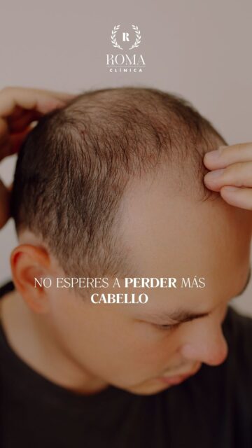 En salud capilar, el momento de actuar también importa.

Esperar a que la pérdida de cabello sea más evidente puede limitar las opciones de abordaje. Por eso, ante los primeros cambios en la densidad, el grosor o la caída del cabello, es recomendable realizar una valoración profesional.

En Clínica Roma estudiamos cada caso de forma individual para identificar las posibles causas, valorar el estado del cabello y establecer un plan de tratamiento personalizado según las necesidades de cada paciente.

No todas las pérdidas capilares son iguales. Y su tratamiento tampoco debería serlo.

¿Has empezado a notar cambios en tu cabello? Solicita tu valoración capilar en Clínica Roma.

📲 951 536 845 / 645 020 214 / 655 538 090
📍 Dirección: Trinidad Grund 7, 1D, Málaga Centro
🌐 Página web: www.clinicasroma.com

#TrasplanteCapilar #SaludCapilar #Alopecia #clinicaroma #malaga