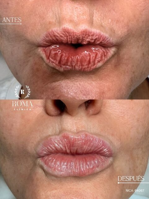 ¿Tus labios también sufren en verano?

Las altas temperaturas, el sol, el cloro, el aire acondicionado o la sal del mar pueden hacer que los labios se deshidraten, pierdan suavidad y se vean más apagados.

La hidratación labial con ácido hialurónico es el tratamiento ideal para devolverles confort, elasticidad e hidratación desde el interior, consiguiendo unos labios más saludables, jugosos y naturales.

Lo mejor es que no está pensado para dar volumen, sino para mejorar la calidad del labio y realzar su aspecto de forma sutil.

Si quieres lucir unos labios hidratados durante todo el verano, solicita tu valoración personalizada. Estaremos encantados de ayudarte.

“Resultados individuales. Cada paciente puede obtener resultados diferentes. Valoración médica previa necesaria.”

📲 951 536 845 / 655 538 090
📍 Dirección: Trinidad Grund 7, 1D, Málaga Centro
🌐 Página web: www.clinicasroma.com

#AumentoDeLabios #malaga #verano #labios #clinicaroma
