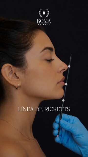 ¿Sabes qué es la línea de Ricketts y qué nos puede decir sobre tu perfil?
En este vídeo, la Dra. Gabriela Molina nos cuenta qué es esta referencia tan utilizada en medicina estética para analizar la armonía y el equilibrio del perfil facial, especialmente la relación entre la nariz, los labios y el mentón.
Porque no se trata de seguir una medida perfecta: cada rostro es único y cualquier tratamiento debe planificarse respetando sus proporciones y naturalidad.
▶️ Dale al play y descubre cómo se utiliza la línea de Ricketts y por qué puede ser importante a la hora de valorar un tratamiento facial.
“Resultados individuales. Cada paciente puede obtener resultados diferentes. Valoración médica previa necesaria.”
📲 951 536 845 / 645 020 214 / 655 538 090
📍 Dirección: Trinidad Grund 7, 1D, Málaga Centro
🌐 Página web: www.clinicasroma.com
#ClinicaRoma #PerfilFacial #LineaDeRicketts #malaga #ArmonizacionFacial