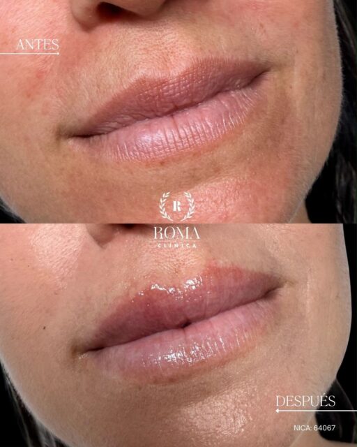 ¿Aumento de labios o hidratación?

No siempre buscamos más volumen. En este caso, después del verano, sus labios necesitaban hidratación, jugosidad y un aspecto más fresco.

El objetivo: respetar su forma natural y conseguir unos labios visiblemente más hidratados y cuidados. 

Porque cada labio necesita un tratamiento diferente. ¿Tú qué buscas: volumen o hidratación?

“Resultados individuales. Cada paciente puede obtener resultados diferentes. Valoración médica previa necesaria.”

📲 951 536 845 / 655 538 090
📍 Dirección: Trinidad Grund 7, 1D, Málaga Centro
🌐 Página web: www.clinicasroma.com

#AumentoDeLabios #malaga #hidratacion #labios #clinicaroma
