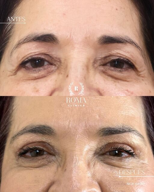 Nuestra querida paciente se realizó una blefaroplastia superior combinada con brow lift, un abordaje que permite trabajar de forma conjunta la zona de los párpados superiores y la posición de las cejas, buscando un resultado armónico y natural.

Procedimiento realizado por nuestra doctora @dra.pinasmaxilofacial. 

Cada paciente es único, por eso la valoración previa es fundamental para determinar el tratamiento más adecuado en cada caso.

¿Te gustaría saber más sobre estos procedimientos? Déjanos tus dudas en comentarios. 

📲 951 536 845 / 655 538 090
📍 Dirección: Trinidad Grund 7, 1D, Málaga Centro
🌐 Página web: www.clinicasroma.com

#clinicaroma #Blefaroplastiasuperior #browlift #MiradaRejuvenecida #malaga