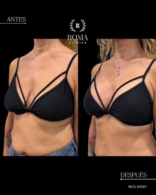 En Clínicas Roma, cada intervención se planifica de forma personalizada, buscando un resultado equilibrado y acorde con la anatomía de cada paciente.
En este caso, se ha realizado una mastopexia con prótesis de 320 cc y proyección moderada, combinando la elevación mamaria con un aporte de volumen para mejorar la forma y la posición del pecho.
• Elevación y remodelación mamaria
• Implantes de 320 cc
• Proyección moderada
• Búsqueda de proporción y naturalidad
📲 Solicita tu valoración personalizada en Clínicas Roma.
“Resultados individuales. Cada paciente puede obtener resultados diferentes. Valoración médica previa necesaria.”
#ClinicasRoma #Mastopexia #MastopexiaConProtesis #CirugiaMamaria #AumentoMamario