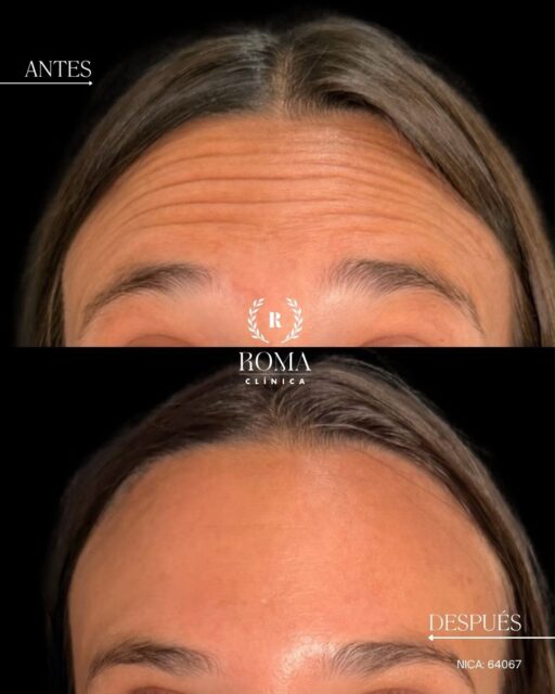 Con el paso del tiempo, las líneas de expresión se hacen más visibles, pero suavizarlas no significa renunciar a la naturalidad.
En este caso, hemos utilizado neuromoduladores para atenuar las arrugas de expresión y conseguir un rostro de aspecto más relajado, fresco y descansado.
El objetivo siempre es el mismo: realzar la belleza natural de cada paciente, sin cambiar aquello que la hace única.
“Resultados individuales. Cada paciente puede obtener resultados diferentes. Valoración médica previa necesaria.”
📲 951 536 845 / 655 538 090 / 645 020 214
📍 Dirección: Trinidad Grund 7, 1D, Málaga Centro
🌐 Página web: www.clinicasroma.com
#ArrugasTercioSuperior #clinicaroma #malaga #Neuromoduladores #LíneasDeExpresión