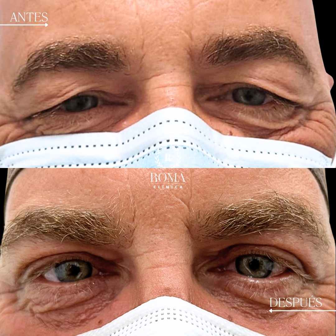 Imagen procedimiento blefaroplastia en paciente