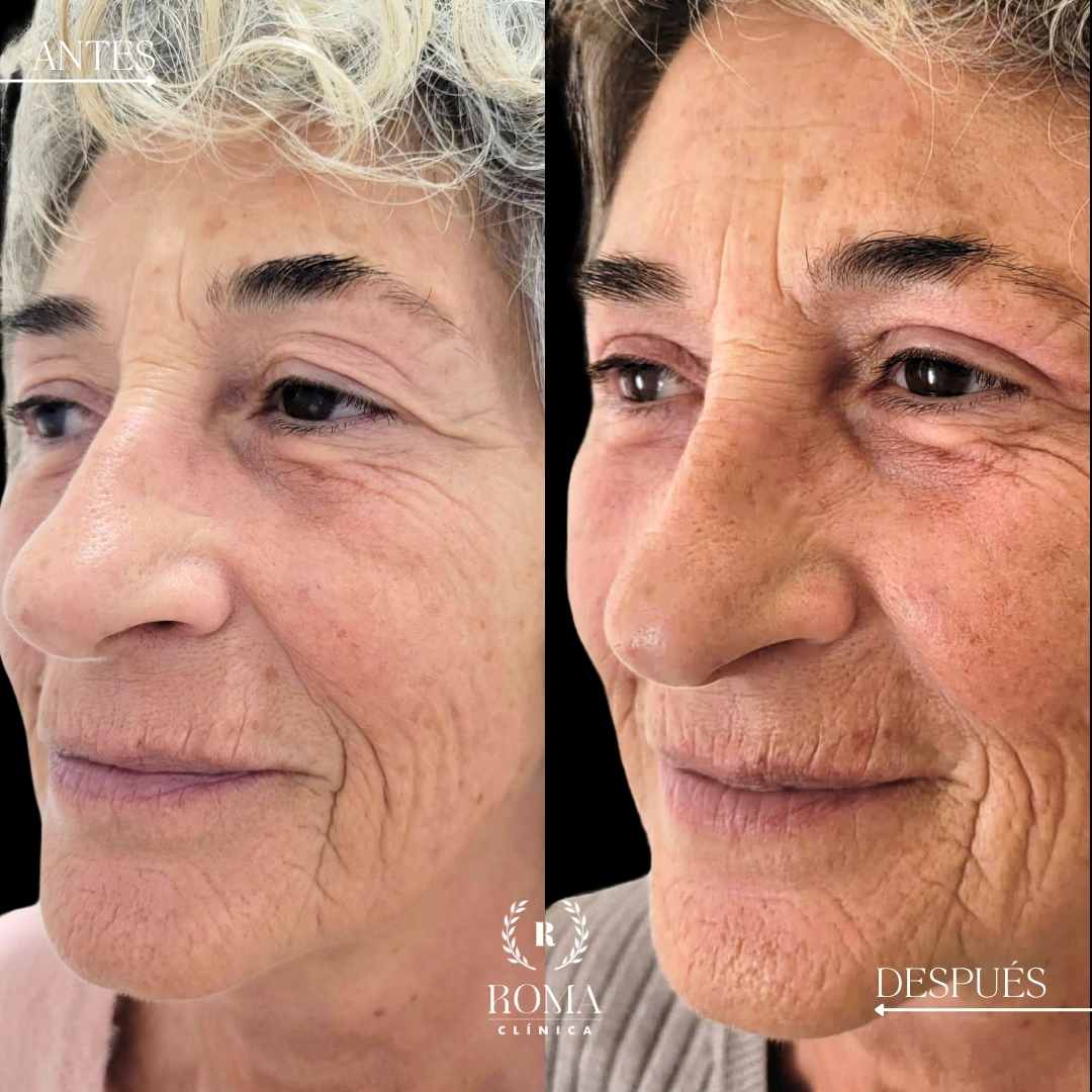 Imagen paciente antes y después procedimiento de blefaroplastia