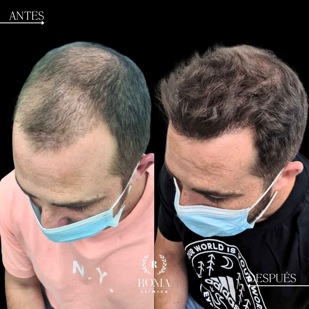 injerto capilar con medicina estetica mlaga, clinica roma