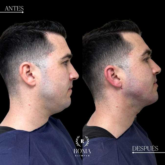 lipopapada resultados en la mejor clinica estetica malaga, clinica Roma