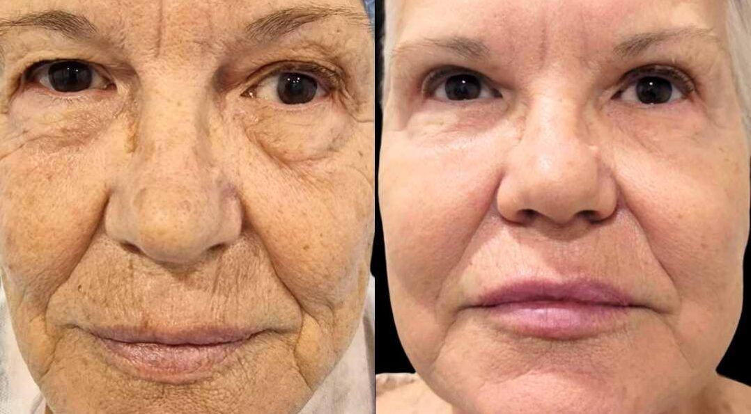 Imagen procedimento blefaroplastia procedimiento antes y después