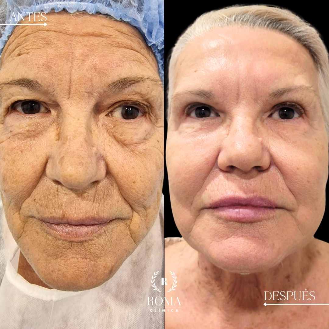 Imagen procedimento blefaroplastia procedimiento antes y después