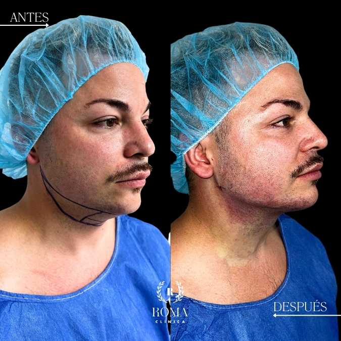 lipopapada resultados en la mejor clinica estetica de malaga, Clinica Roma