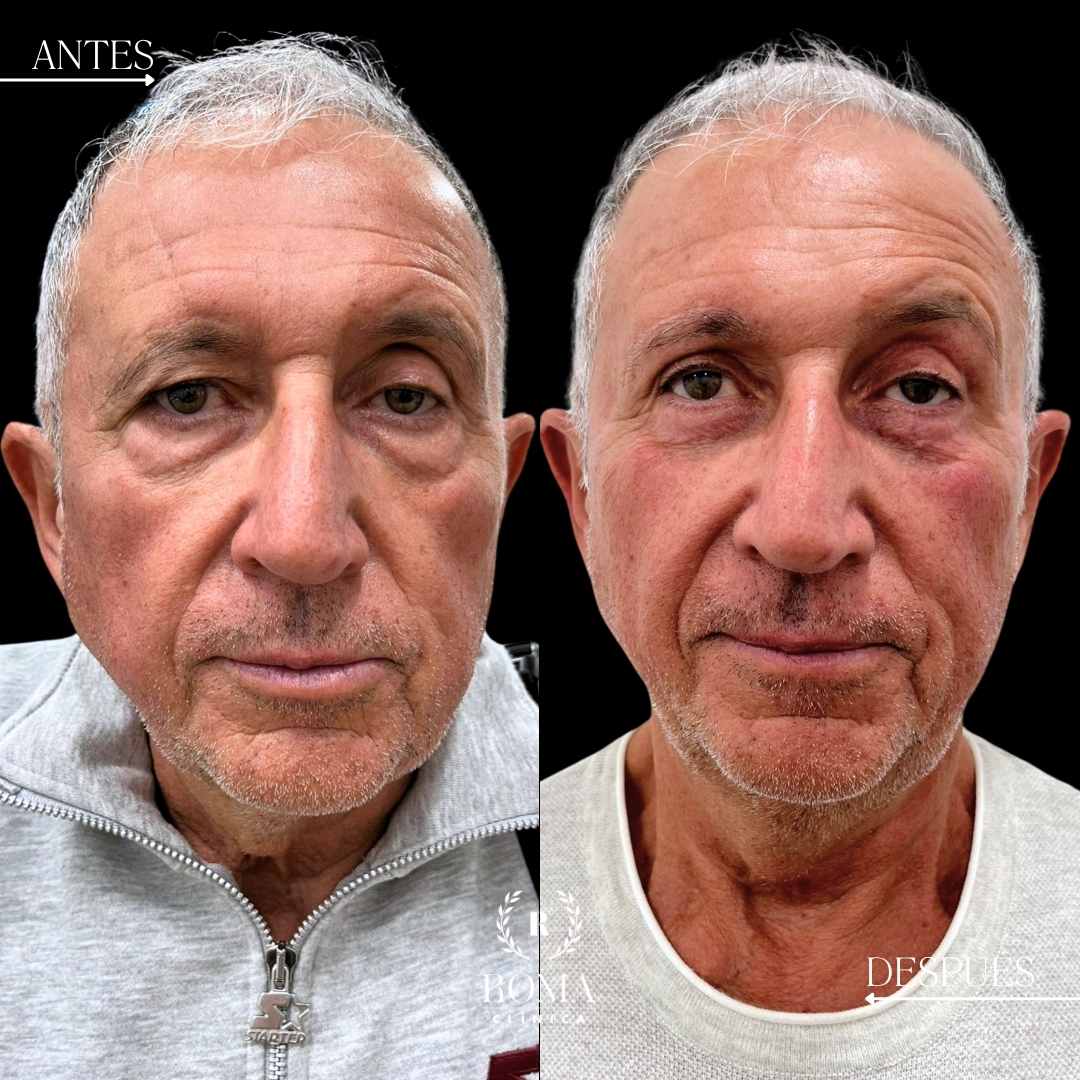 Imagen paciente blefaroplastia resultados