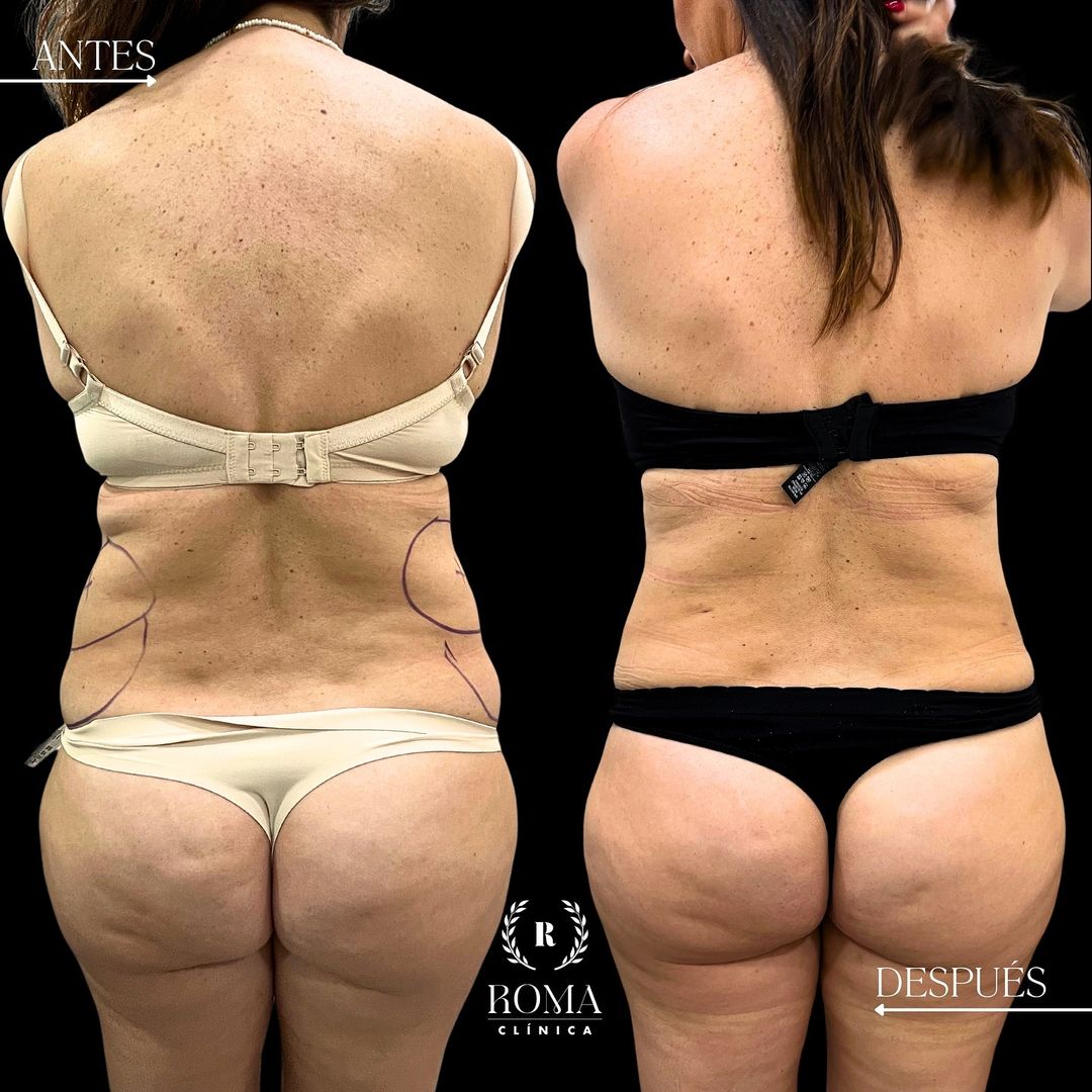resultados lipolaser en la mejor clinica estetica malaga, clinica Roma