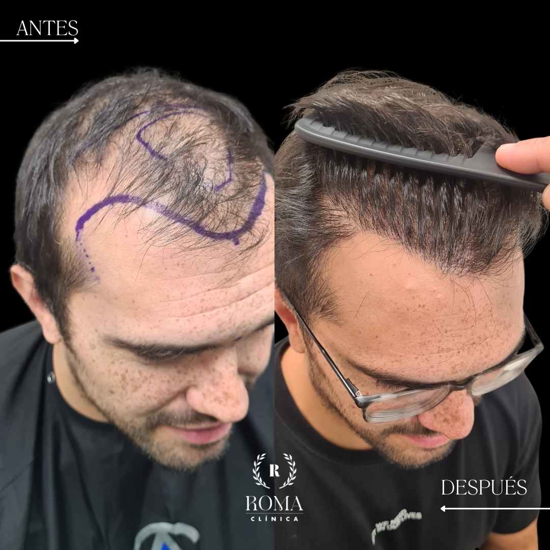 resultado injerto capilar en la mejor clinica estetica malaga, Clinica Roma