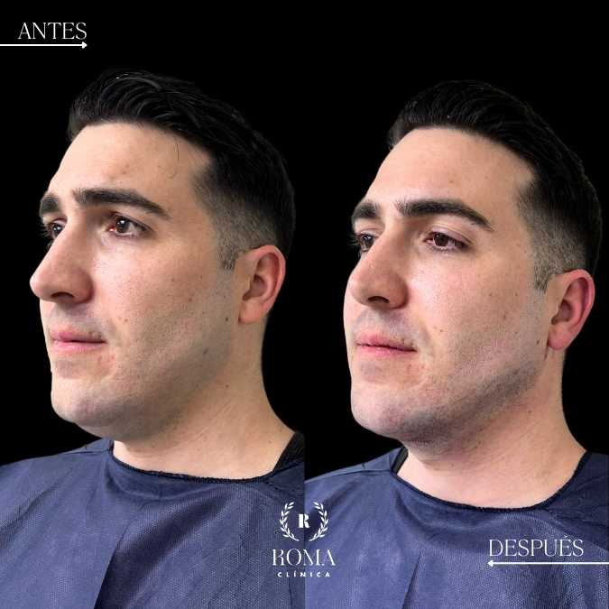 tratamiento de lipopapada en la mejor clinica estetica malaga, Clinica Roma