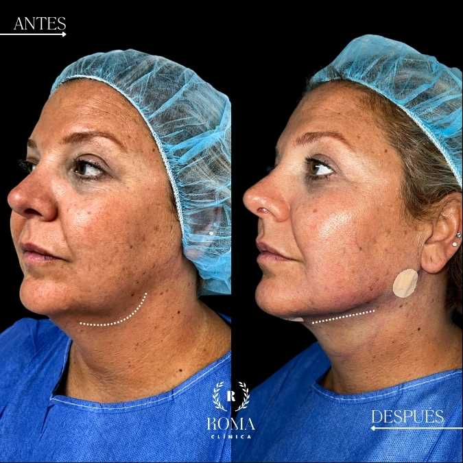 medicina estetica en la mejor clinica estetica malaga, Clinica roma, tratamiento de lipopapada