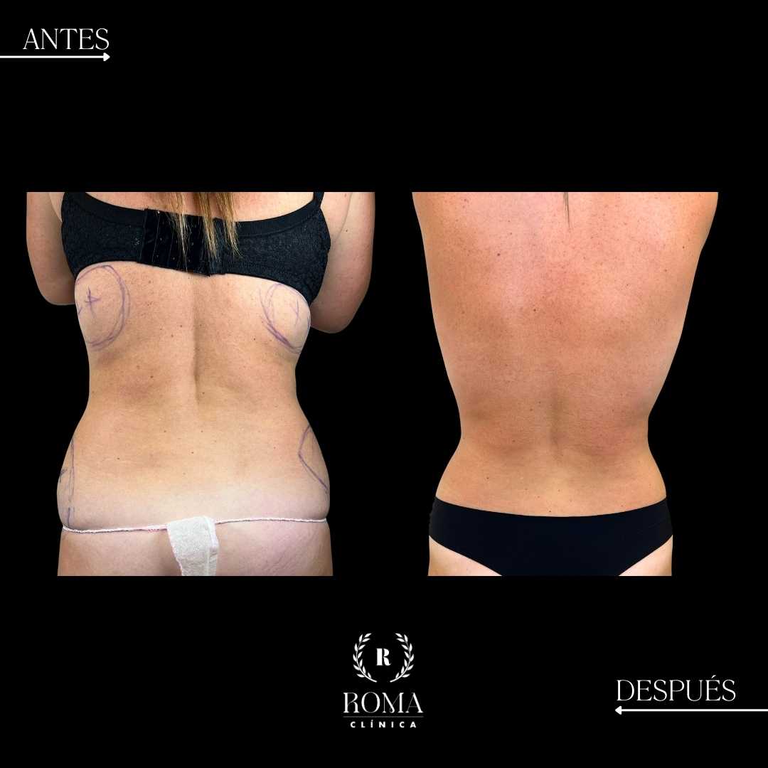 Lipolaser tratamiento en la mejor clinica estetica malaga, clinic a Roma