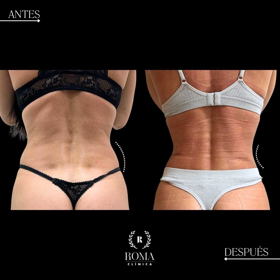 tratamiento estetico lipolaser en la mejor clinica estetica malaga