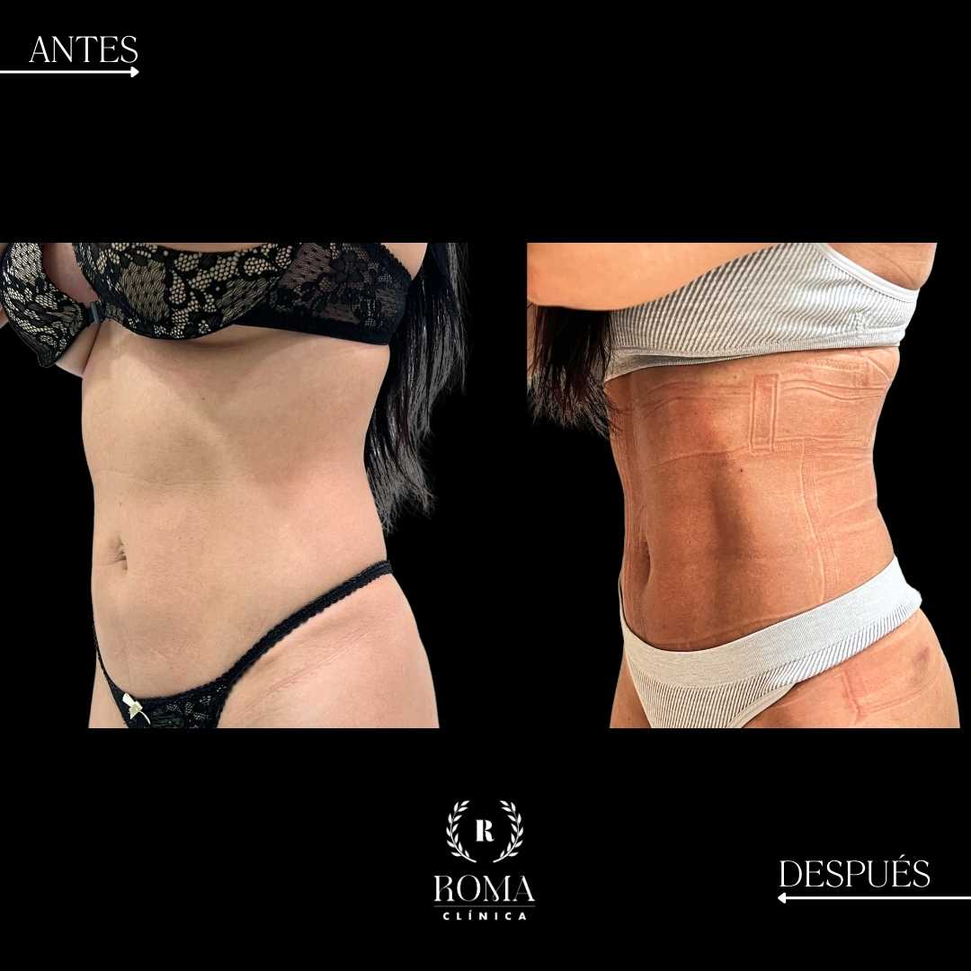 resultados naturales con lipolaser y la mejor clinica estetica malaga, Clinica Roma