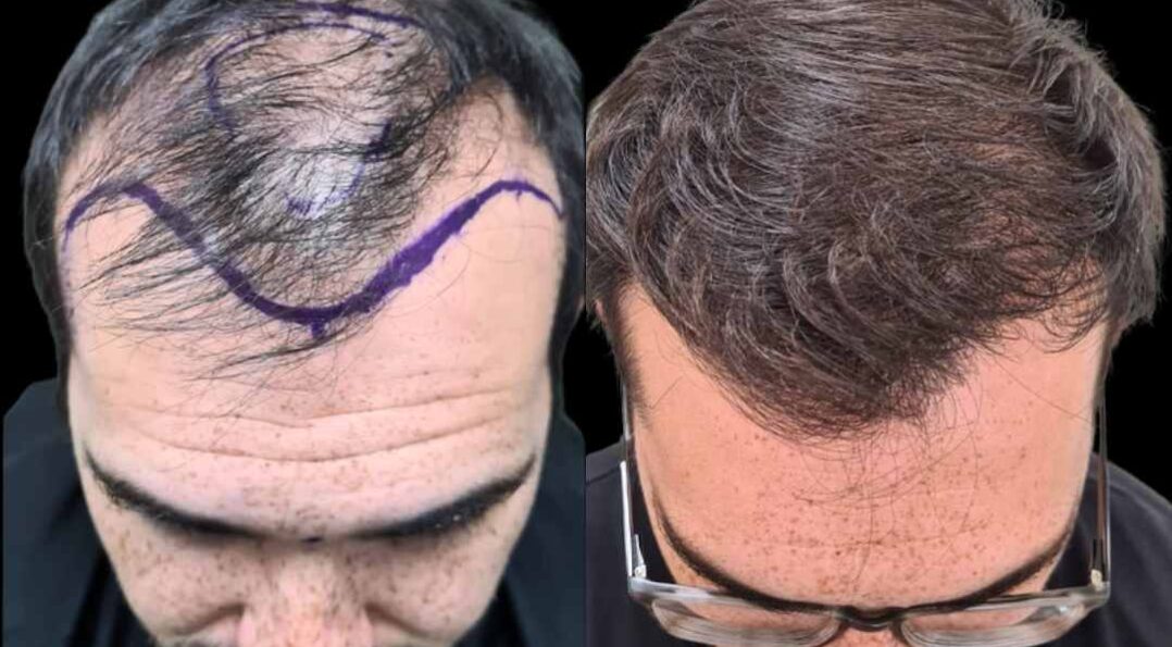 resultado de injerto capilar en la mejor clinica estetica malaga, Clinica Roma