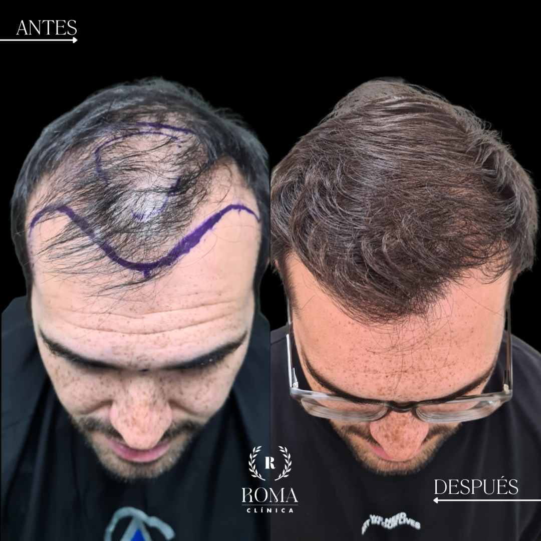 resultado de injerto capilar en la mejor clinica estetica malaga, Clinica Roma