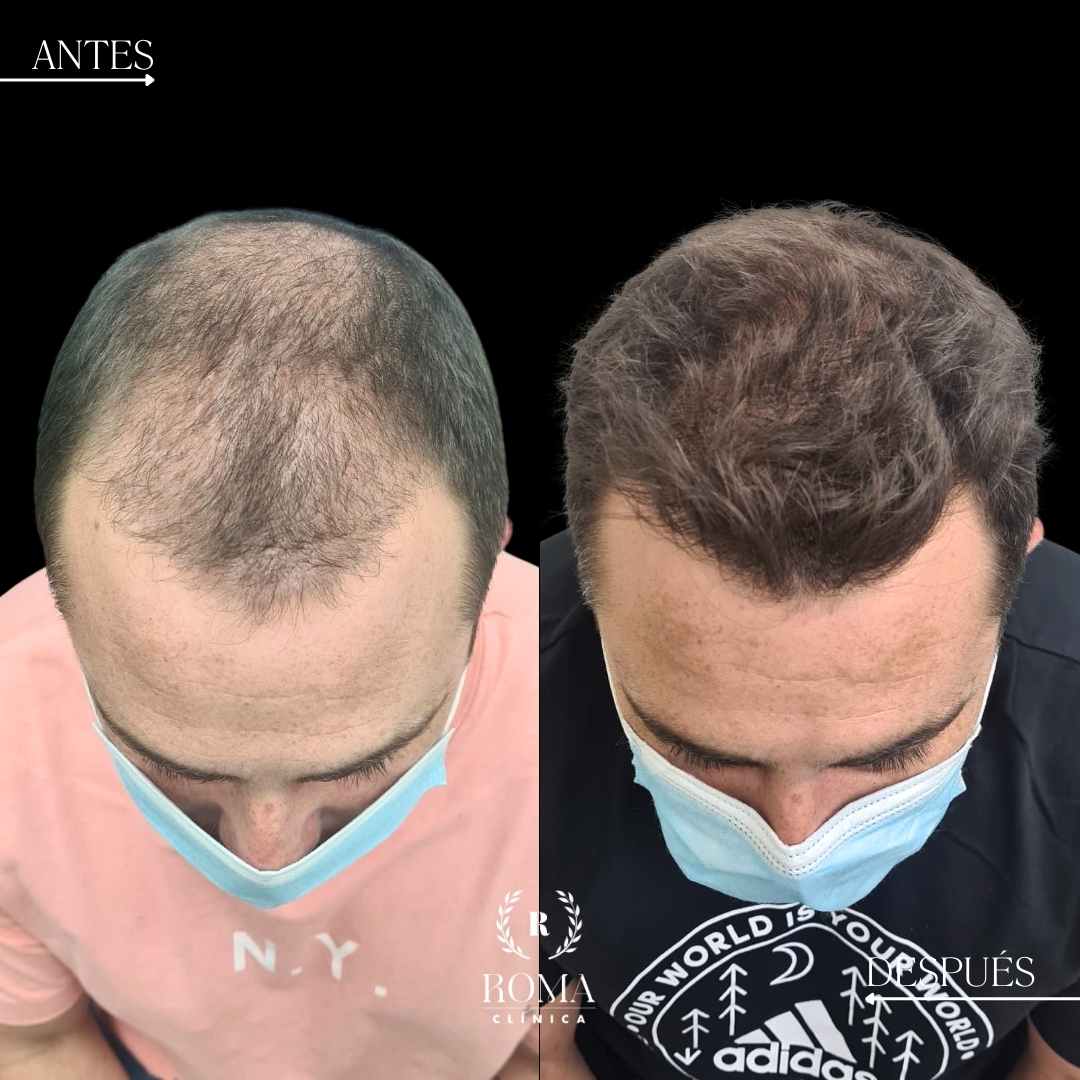 tratamiento estetico capilar en la mejor clinica estetica malaga, clinica roma