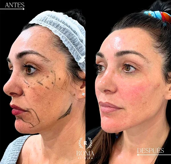Tratamiento facial ideal para reducir arrugas, mejorar la luminosidad y revitalizar la piel en Málaga, medicina estetica facial