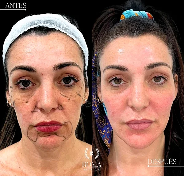 Paciente satisfecha tras recibir tratamiento facial en Clínica Roma, con resultados visibles de frescura y vitalidad en el rostro, en la mejor clinica estetica Malaga