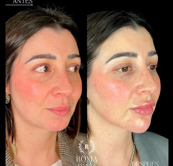 Imagen con zonas del rostro que se benefician del tratamiento facial antiedad en nuestra clinica estetica en Málaga.