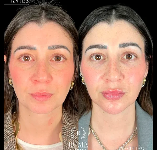Resultado visible de un rostro más uniforme, hidratado y radiante gracias al tratamiento facial de Clínica Roma en Malaga.