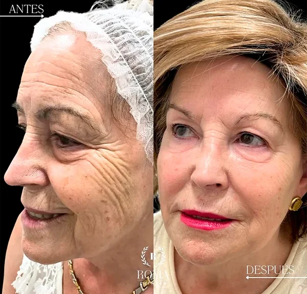 Aplicación de tecnología estética de última generación para rejuvenecer el rostro en Clínica Roma, centro estetico en Malaga.