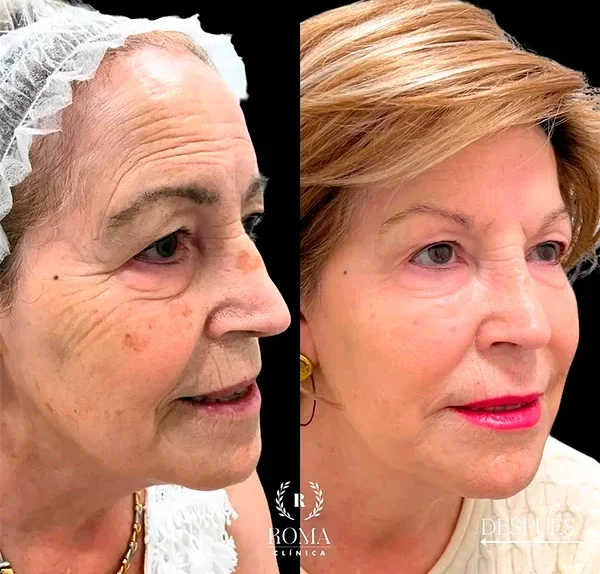 Resultado real del tratamiento facial con efecto natural en la piel, realizado en Clínica Roma, especialistas en estetica facial en Malaga.