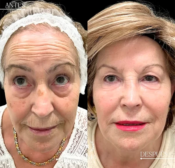 Asesoramiento personalizado en Clínica Roma para seleccionar el mejor tratamiento de rejuvenecimiento facial según cada tipo de piel, en la mejor clinica estetica Malaga