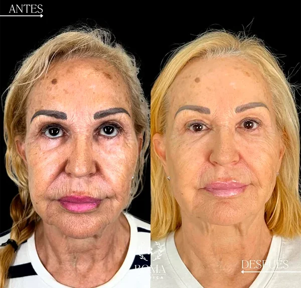 Comparativa visual que muestra la mejora en la textura y firmeza de la piel tras el tratamiento facial en Malaga, en la mejor clinica estetica