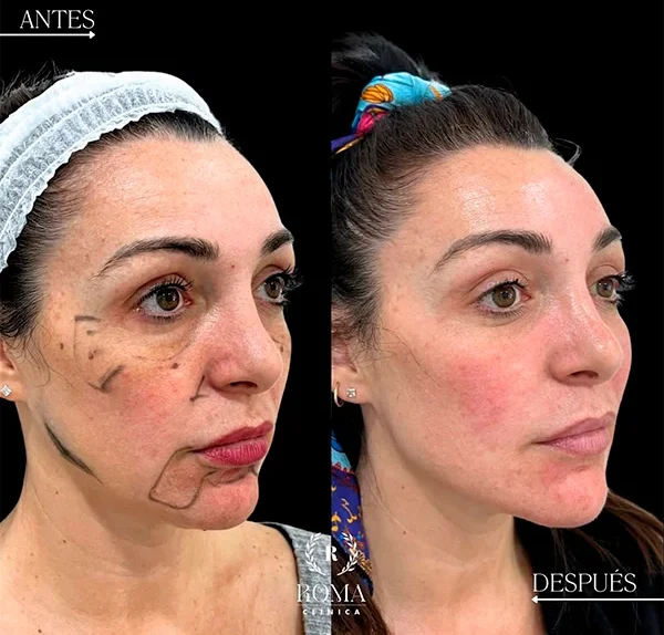Procedimiento de rejuvenecimiento sin cirugía que mejora la textura y firmeza del rostro en nuestra clinica estetica de Malaga.