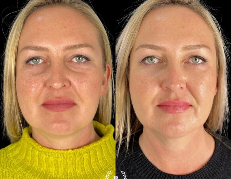 Dale un nuevo aspecto a tu rostro con nuestro relleno de ojeras 