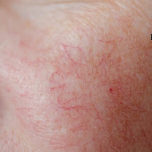 Elimina las arañitas de tu rostro fácil y rápido