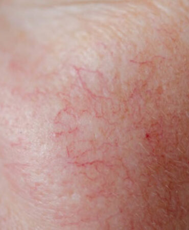 Elimina las arañitas de tu rostro fácil y rápido