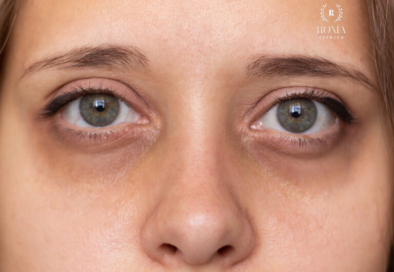 Blefaroplastia superior e inferior para renovar tu mirada