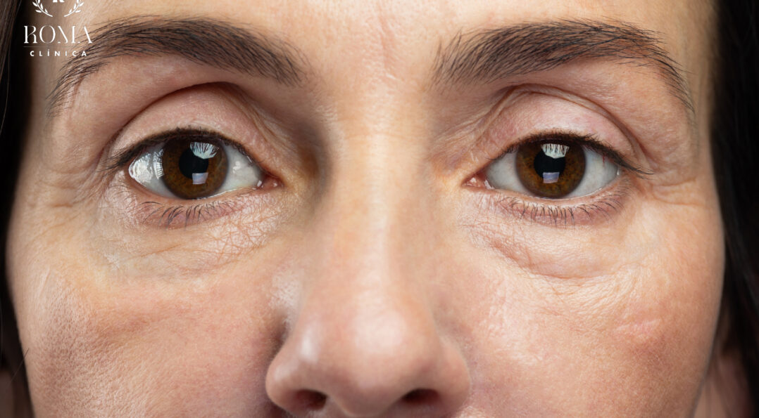 Mejor procedimiento para disminuir los signos de la edad en Málaga