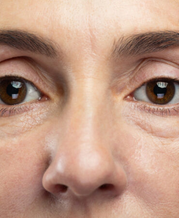 Mejor procedimiento para disminuir los signos de la edad en Málaga