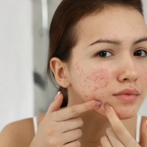 Disminuye la apariencia del acné en Málaga