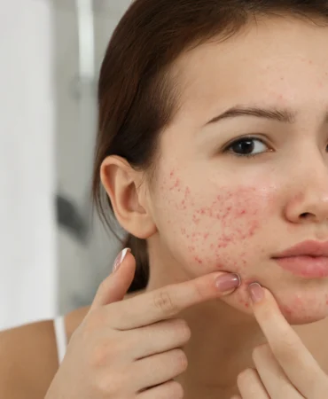 Disminuye la apariencia del acné en Málaga